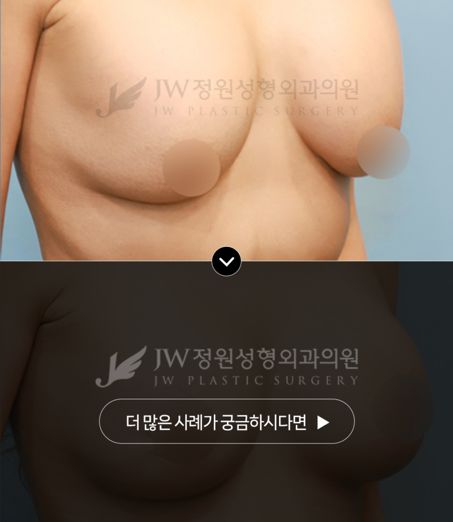 정원성형외과 가슴 구형구축 베이커 단계