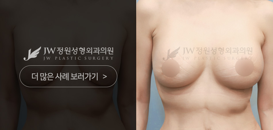 정원성형외과 가슴재수술 상담 안내