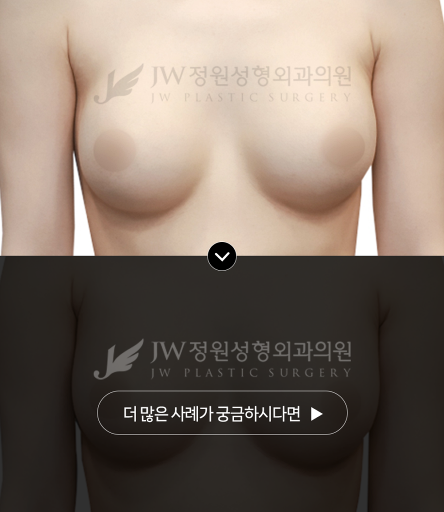 정원성형외과 가슴비대칭 보형물 진단