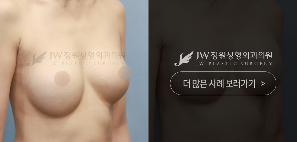 JW정원성형외과 사례