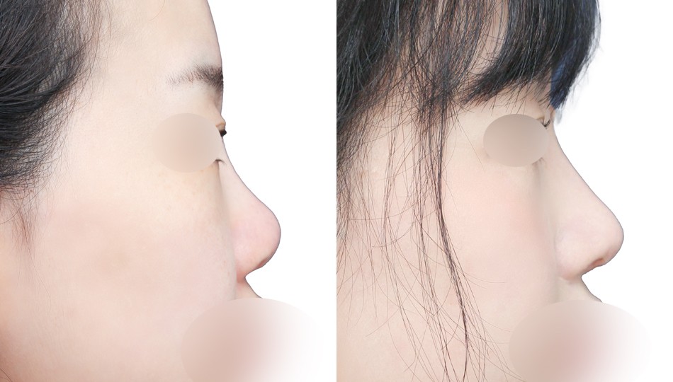 JW정원성형외과 코 전후 비교 이미지
