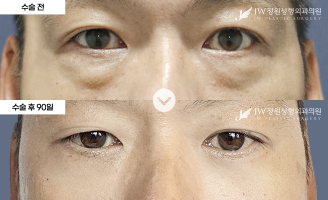 JW정원성형외과 눈 전후 비교 이미지