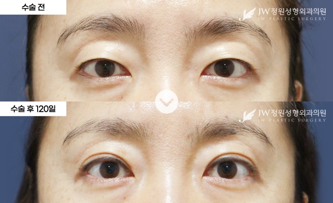JW정원성형외과 눈 전후 비교 이미지