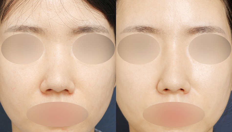 JW정원성형외과 코 전후 비교 이미지
