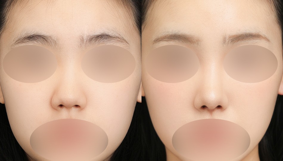JW정원성형외과 코 전후 비교 이미지
