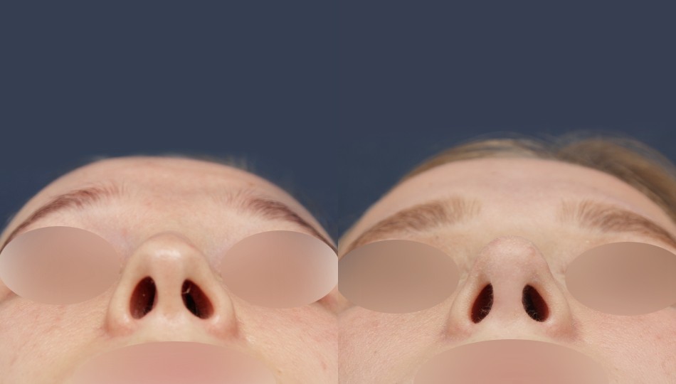 JW정원성형외과 코 전후 비교 이미지