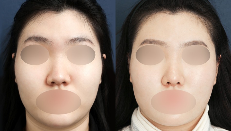 JW정원성형외과 코 전후 비교 이미지